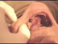 Implante dentário e prótese definitiva