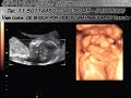 GRAVIMAGEM 49 (ULTRA-SOM 3D 4D GESTAÇÃO DE 20 SEMANAS) GRAVIMAGEM 49 (ULTRA-SOM 3D 4D GESTAÇÃO DE 20 SEMANAS)