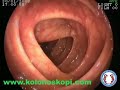 kolonoskopi colonoscopy kolonoskopi colonoscopy