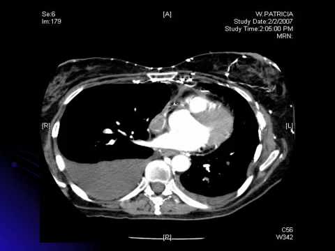 how to treat svc syndrome
