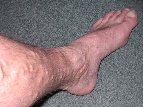 how to cure spider veins