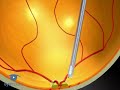Vitrectomy: Peeling The Posterior Hyaloid VR1 Basic Techniqu Vitrectomy: Peeling The Posterior Hyaloid VR1 Basic Techniqu