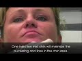 Botox Procedure/Chin-Radiant Complexions Dermatology Clinics Botox Procedure/Chin-Radiant Complexions Dermatology Clinics