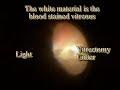 Removal of a 6 month old vitreous hemorrhage using 25 gauge instruments. This 74 year old woman has had intermittent bleeding in this eye for 3 years from a branch retinal vein occlusion.  Six month ago, she had severe vision loss from a vitreous hemorrhage.  She had cataract surgery 3 months ago.  Her intraocular pressure rose after a YAG capsulotomy to 38 mmHg which is dangerously high.  The intraocular pressure rose because some of the old blood cells from the vitreous clogged the drainage channels of the eye.  This is called ghost cell glaucoma.  She had this surgery because of the rise in intraocular pressure and because of her longstanding poor vision from the vitreous hemorrhage.  There is a sound gap in the video for about 20 seconds.