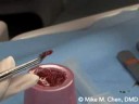 Immediate Placement and PRP