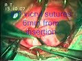 Medial Rectus Resection for Divergent Squint,SudhalkarEyeHos