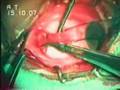 Medial Rectus Resection for Divergent Squint,SudhalkarEyeHos