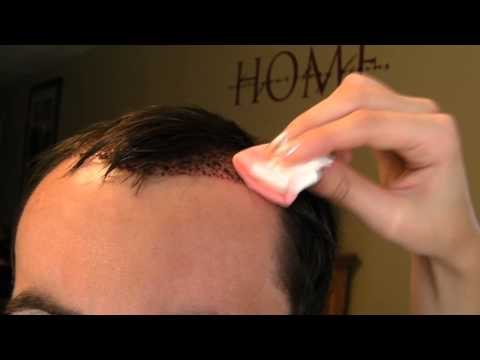 how to remove scabs after hair transplant