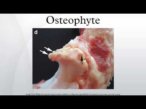 how to eliminate osteophytes