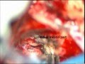 Acoustic schwannoma-microsurgery-PRESERVATION OF FACIAL NERVE-dr suresh dugani/HUBLI/INDIA
