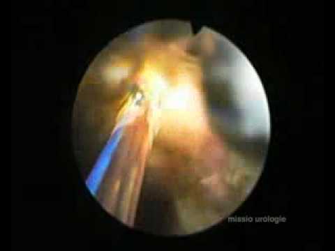 HPS Green Light Laser Teil 2