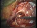 Brain Tumor Resection Brain Tumor Resection