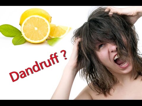 how to remove dandruff