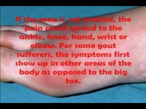 how to get rid out gout
