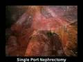 Single Port Nephrectomy with CambridgeEndo Scissors