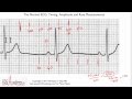 ECG Interpretation, Determining Rate, Part 6-3