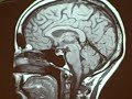 Normal Sagittal MRI