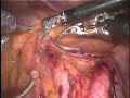 da Vinci / Robotic Aortic Lymph Node Dissection da Vinci / Robotic Aortic Lymph Node Dissection
