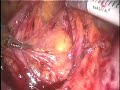 da-vinci-standard-robotic-aortic-lymph-node-dissection.html