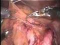 Robotic Aortic Lymph Node Dissection