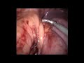 Sleeve gastrectomy