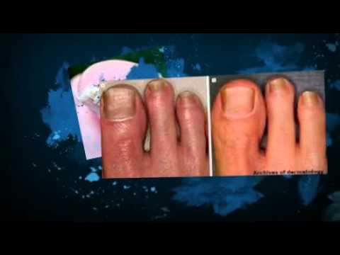 how to kill toenail fungus vicks vapor rub