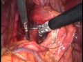Hiatus Hernia Laparoscopic Repair Hiatus Hernia Laparoscopic Repair