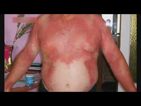 Чем лечить ожоги от борщевика в домашних условиях 54 Чем лечить ожоги от борщевика в домашних условиях 105