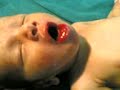 neonatal subtle seizure