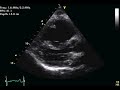 Severe Pulmonary Hypertension