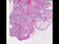 Histopathology Breast--Ductal carcinoma in situ