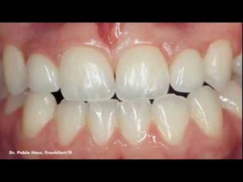 sercon zirconium all ceramic