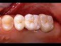 Cercon zirconium all ceramic