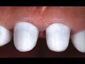 Cercon zirconium all ceramic Cercon zirconium all ceramic