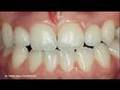 Cercon zirconium all ceramic