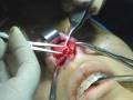 Rhinoplasty In the Operating Room - Vestibular Tissue Release