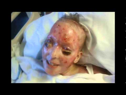 how to treat 4th degree burns