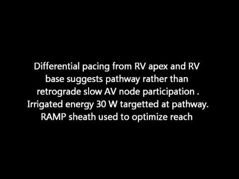 how to treat junctional tachycardia