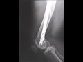 X rays of my leg X rays of my leg
