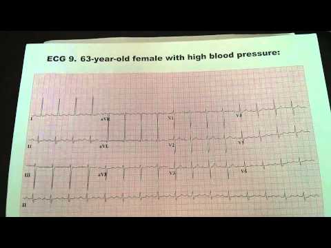 how to treat abnormal ekg