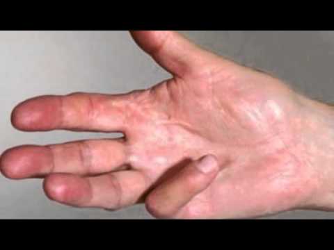 how to treat jersey finger