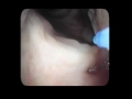 Since Age 3 I've been receiving this procedure to treat Laryngeal Papillomatosis- a virus I contracted from my birth mother that forms benign growths on my vocal cords causing, at times, severe hoarseness. After over 40 surgeries in the operating room I finally got the guts to begin treating the disease in office. This video is of my 2nd in office procedure on July 25, 2011, performed by the fabulous Dr. Albert Merati at the University of Washington Medical Center. There are only minor amounts of papilloma for this excision but you'll get to see all the way into my trachea and the openings of my bronchial tubes. I am awake during the procedure, a point validated by the sounds of me gagging.