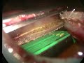 Sleeve Gastrectomy Sleeve Gastrectomy