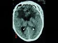 parafalcine huge meningioma