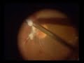 Retinal Surgery - 23 Gauge sutureless vitrectomy