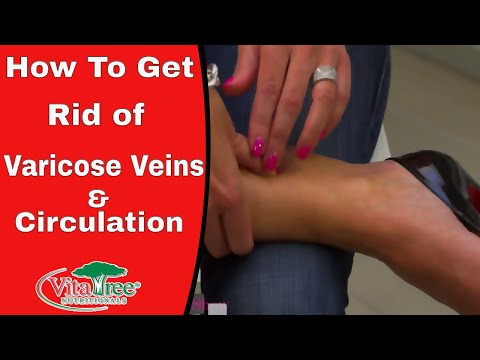 how to avoid varicose veins