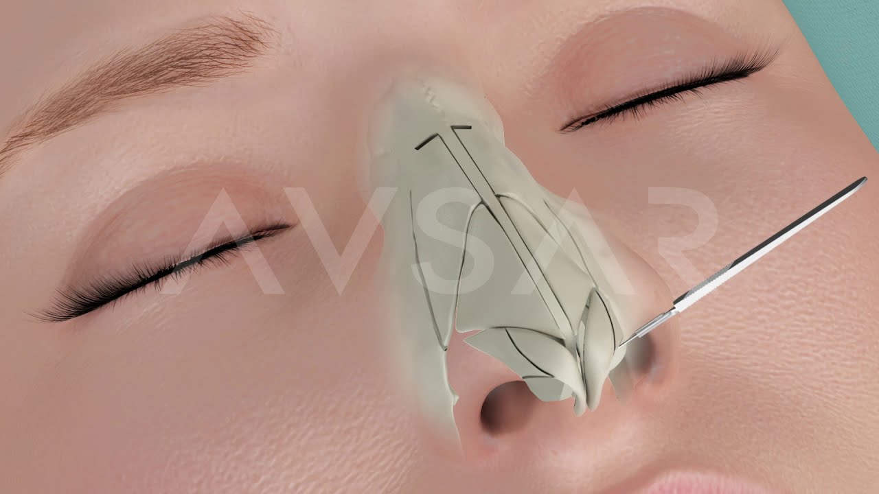 Video Endoscopic Micro Rhinoplasty Dr. Avşar in Istanbul Turkey