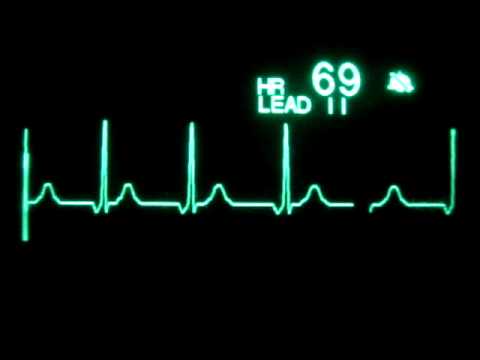 how to treat junctional tachycardia
