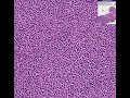 Histopathology Salivary gland--Extranodal marginal zone B-ce Histopathology Salivary gland--Extranodal marginal zone B-ce