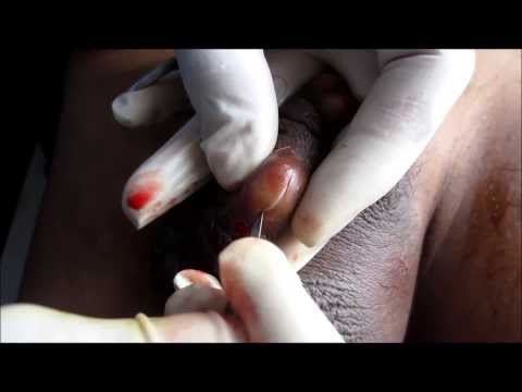 how to drain testicular cyst